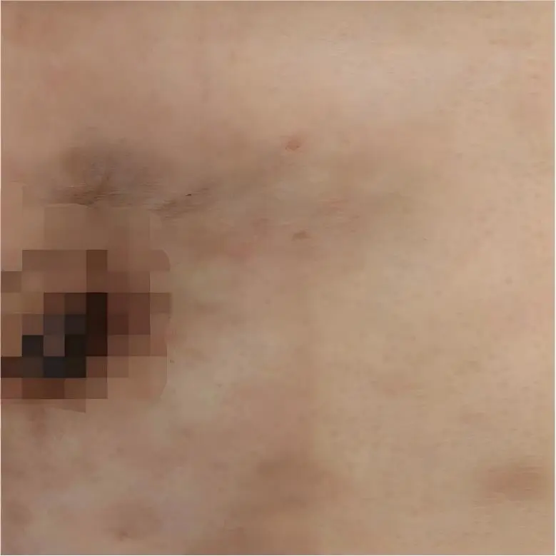 After treatment: wounds fully healed with only mild residual pigmentation, and chest wall rash largely resolved on the left side