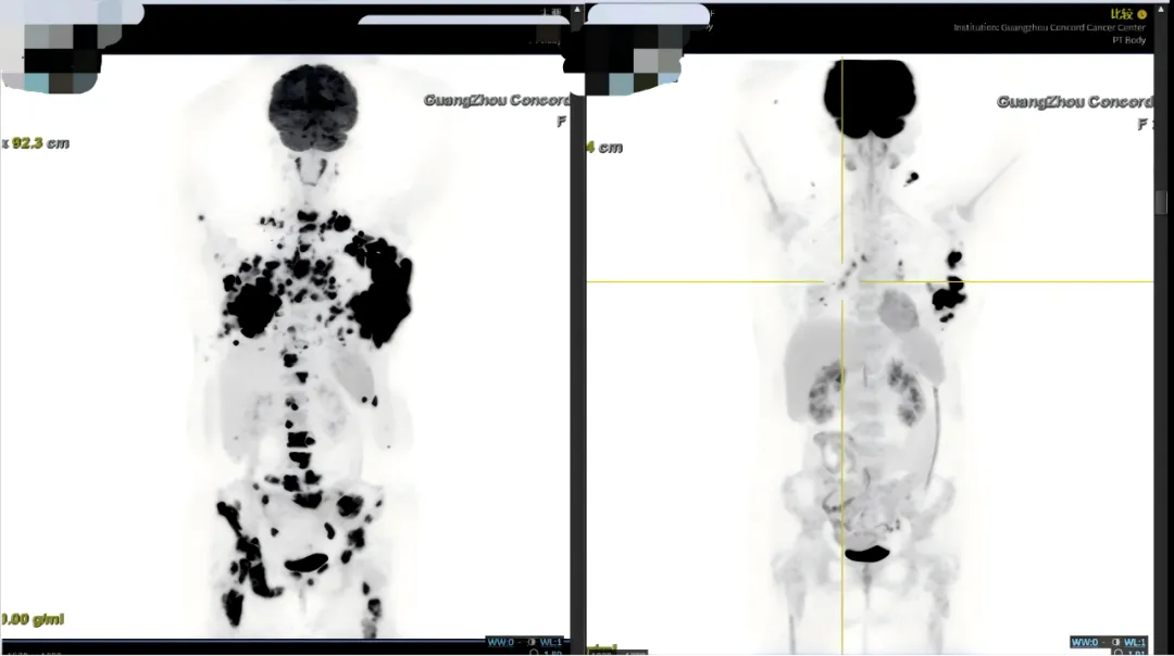 PET-CT comparison before and after proton therapy
