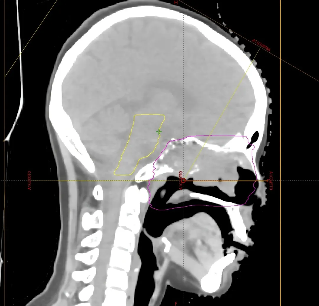 Sagittal CT showing a non-coplanar proton field running parallel to the brainstem while treating a skull-base target