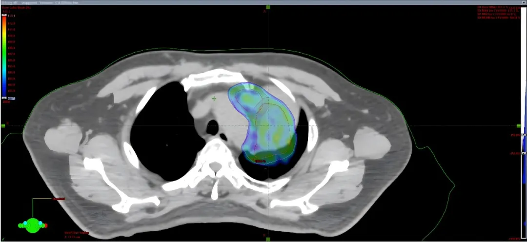 Initial planning CT with the original proton treatment plan for a lung cancer patient