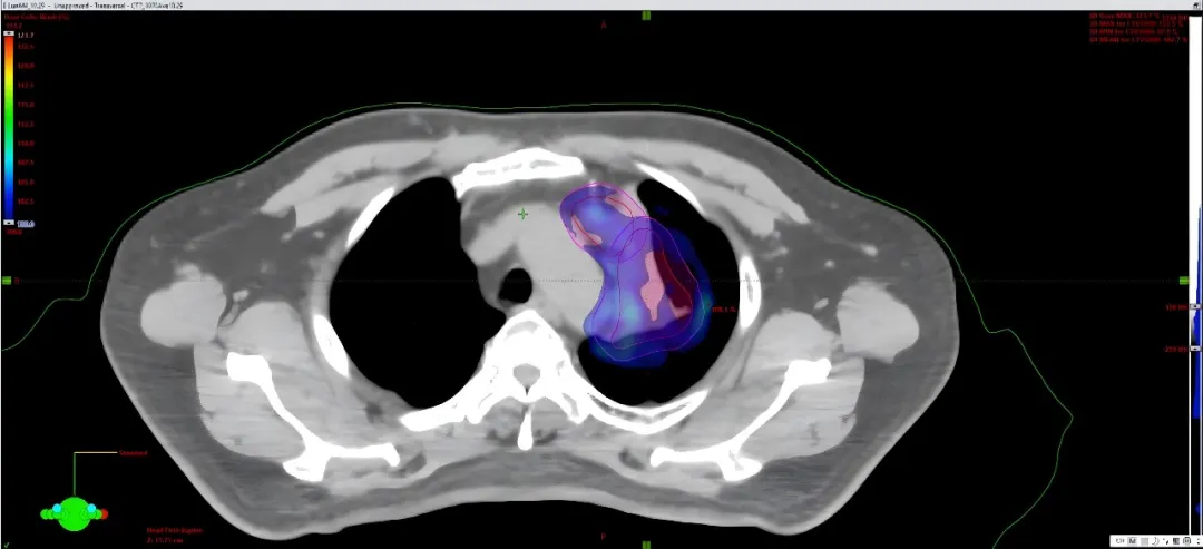 CT re-scanned on day five of treatment showing dose undercoverage after tumour shrinkage